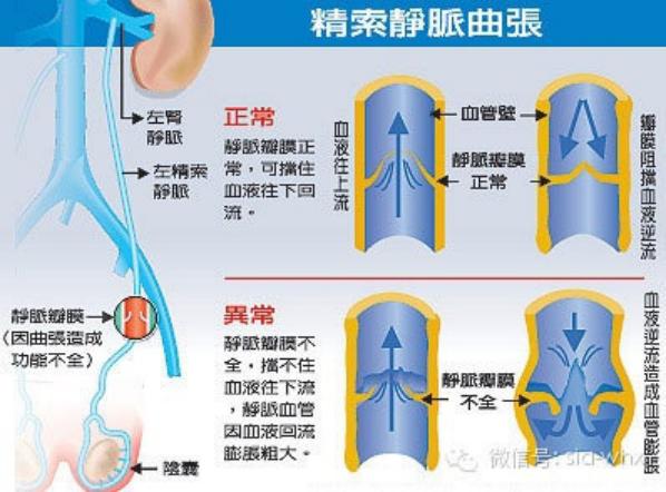 關(guān)于2021年征兵精索靜脈曲張標(biāo)準(zhǔn)的探討，2021年征兵精索靜脈曲張標(biāo)準(zhǔn)深度解析