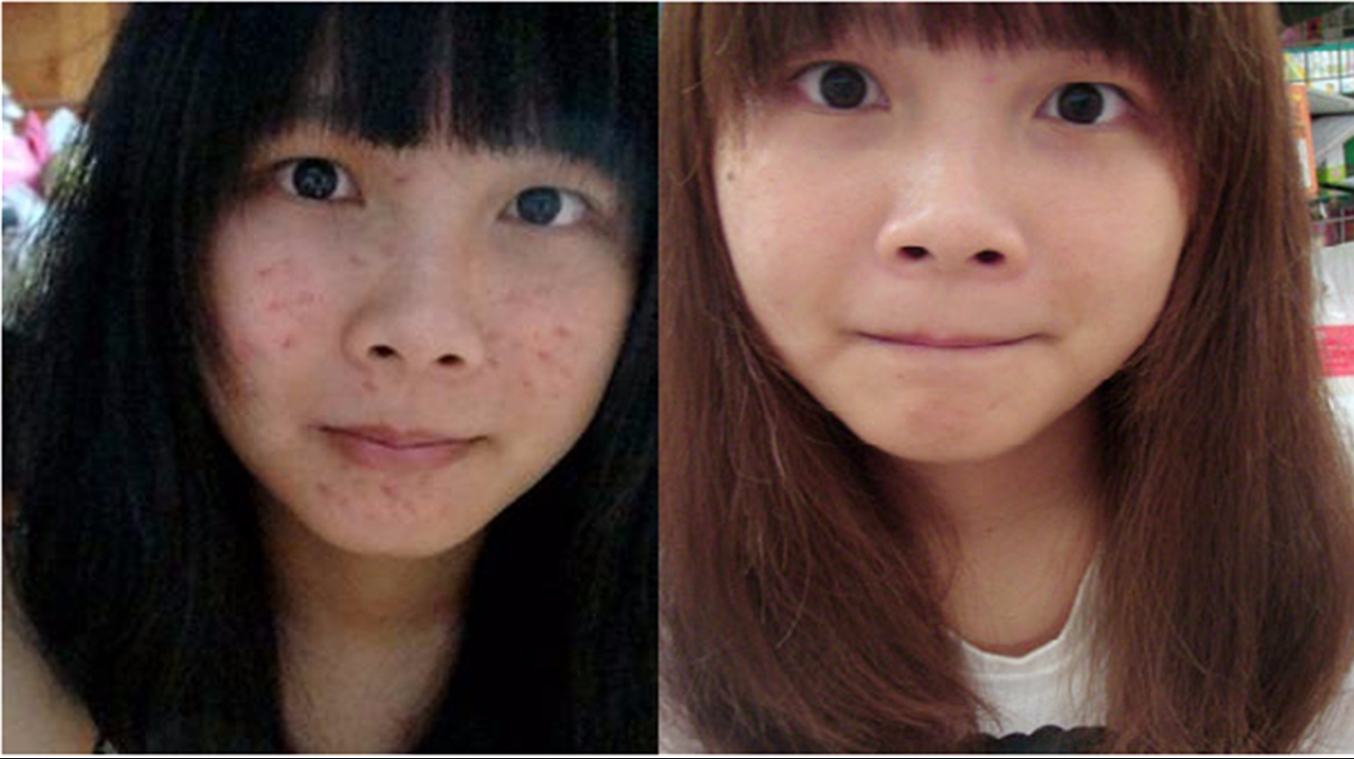 如何去除痘印，全面解析痘印消除方法，全面解析，痘印消除攻略，重塑肌膚無(wú)暇美！