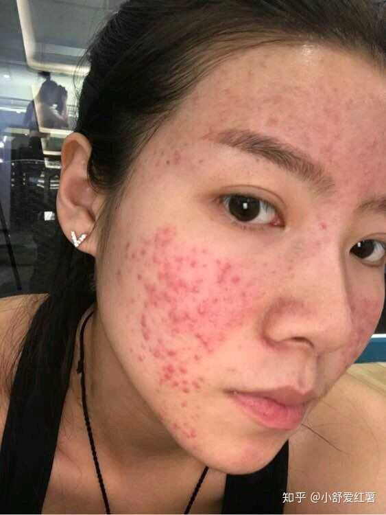 如何有效去除臉上的痘印——全方位指南，全方位指南，如何有效去除臉上痘印的方法