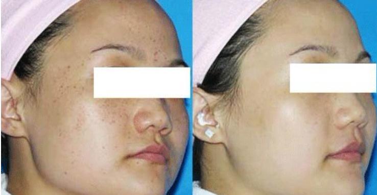 激光祛斑后需要注意的五大事項(xiàng)，激光祛斑后的五大注意事項(xiàng)詳解