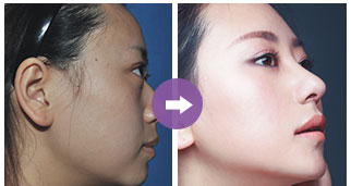 鼻翼縮小手術費用