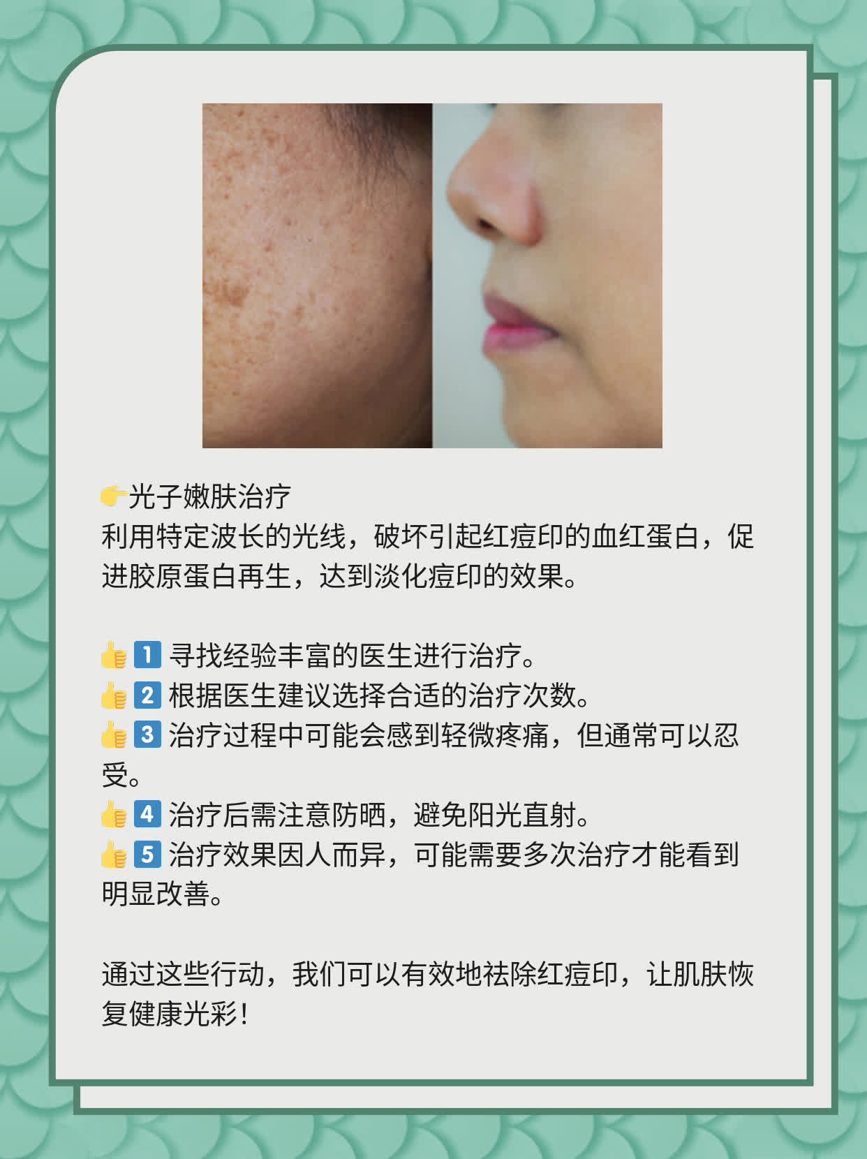 如何有效去除紅痘印，一站式解決方案，一站式解決紅痘印問題，有效去除方法大全