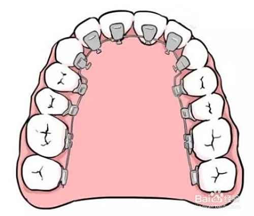 牙套價(jià)格詳解，裝一個(gè)牙套需要多少錢(qián)？，牙套價(jià)格全解析，裝牙套需要多少錢(qián)？
