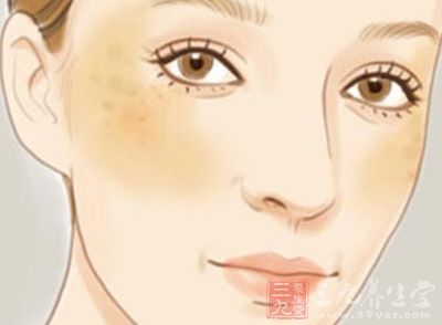 怎樣祛除黃褐斑最有效的方法，最有效的黃褐斑祛除方法