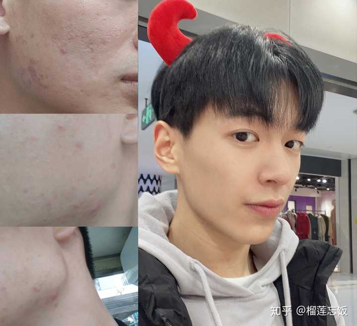 如何有效去除臉上的痘印——全方位指南，全方位指南，如何有效去除臉上痘印的方法