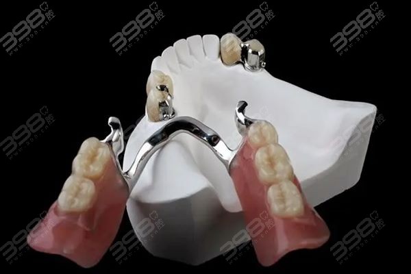 鑲一顆牙大概需要多少錢——全面解析鑲牙費用因素，鑲一顆牙的費用解析，全面探討鑲牙費用因素及大概價格