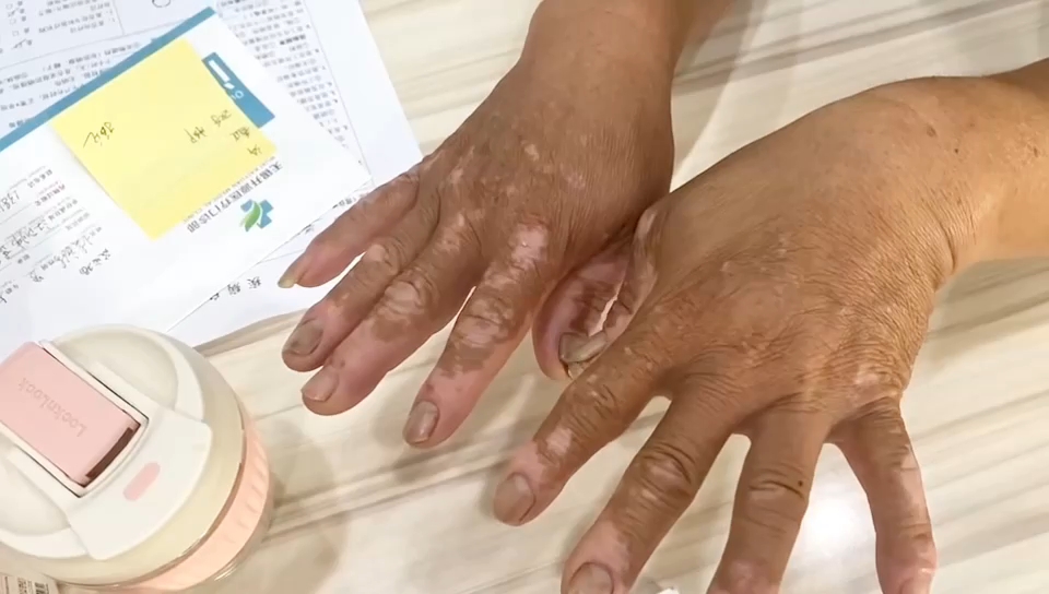 手銀過度早迣，藥物治療與效果解析，手銀過度導(dǎo)致的早迣，藥物治療與效果解析